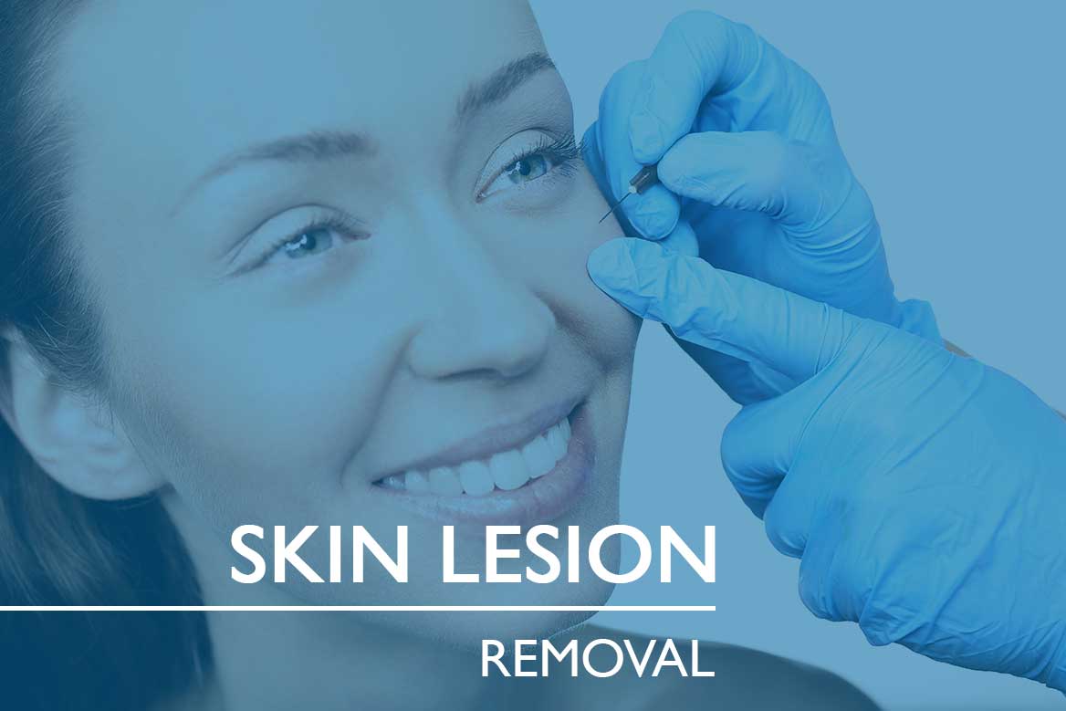 Skin Lesion Removal – OSE Surgery Center